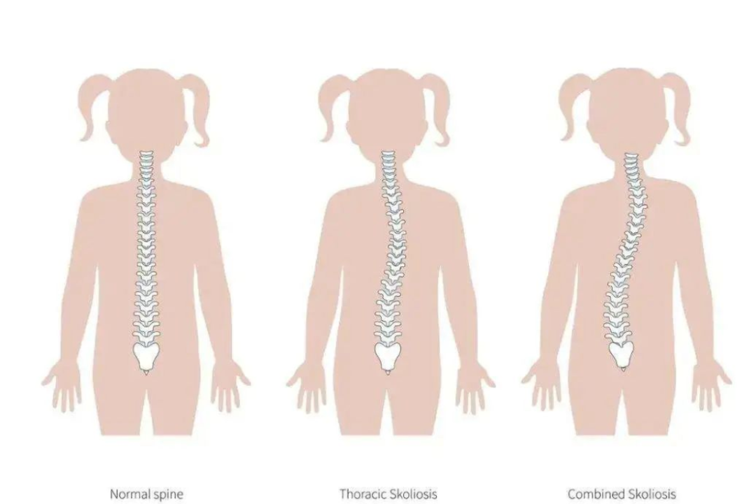 如何自測孩子是否脊柱側彎