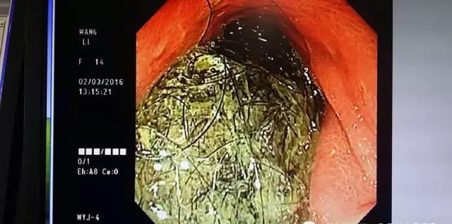 9歲女孩胃里取出直徑4厘米頭發(fā)團(tuán)