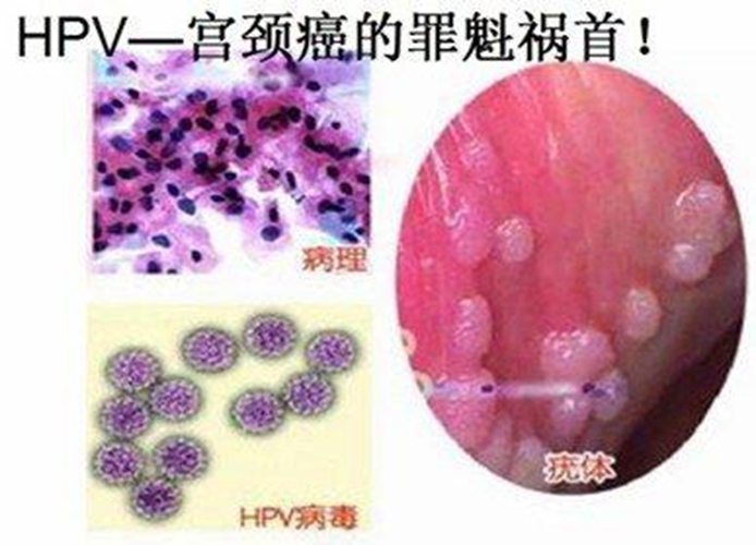 一碼一肖一特馬報(bào),女子美甲后感染HPV病毒長(zhǎng)出菜花